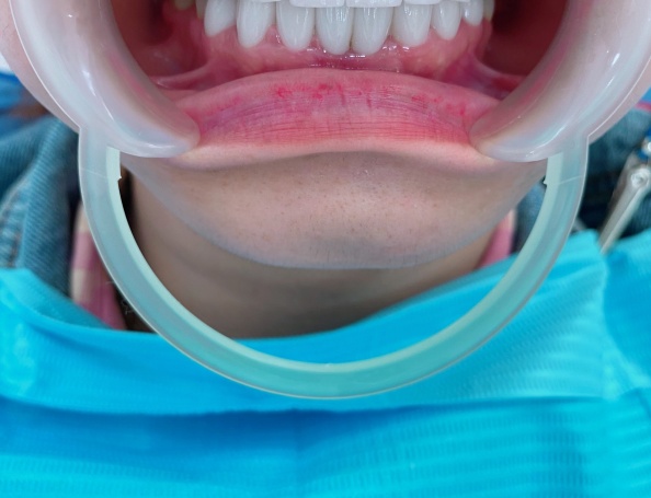KH: KIM QUYỀN - kết hợp phẫu thuật làm dài thăn răng + 18 sứ Zolid