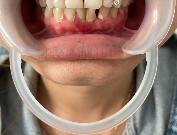 KH: KIM QUYỀN - kết hợp phẫu thuật làm dài thăn răng + 18 sứ Zolid